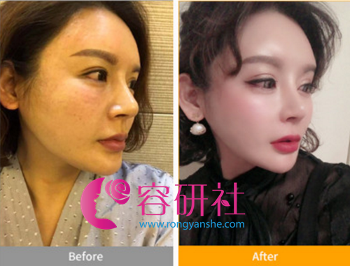 韩国宝士丽整形医院鼻基底假体侧面案例—改善面部凹陷