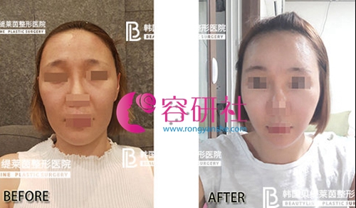 韩国贝缇莱茵整形外科面部吸脂案例