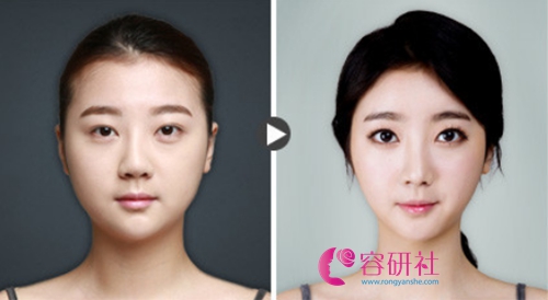 韩国贝缇莱茵整形医院面部吸脂术真实对比案例