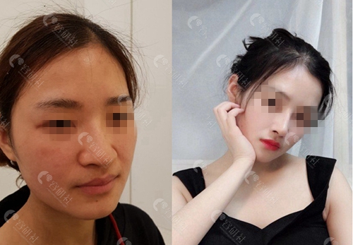 韩国纯真整形 外科鼻头肉改善案例