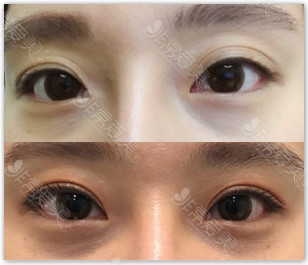 韩国初雪医院双眼皮修复案例