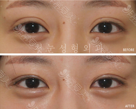 韩国人常去眼部修复医院