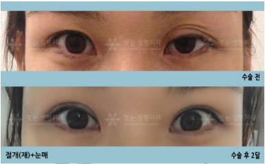 韩国初雪整形外科眼部修复