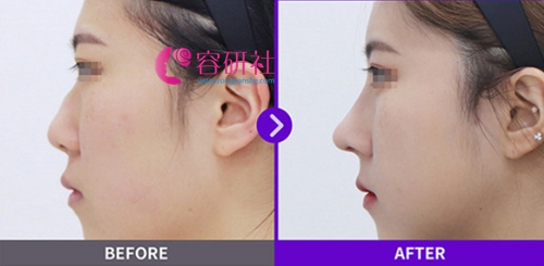 韩国美迪莹整形外科鼻综合修复手术前后案例对比