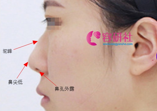 韩国美迪莹整形外科鼻综合修复术前案例