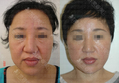 韩国bio面颈部拉皮手术对比案例