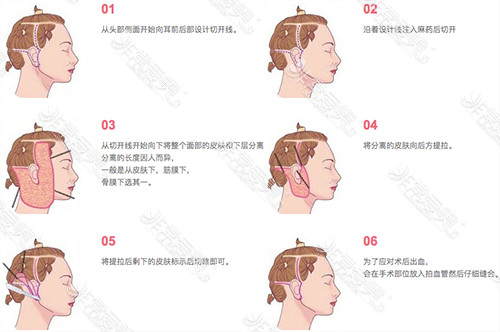 韩国bio面颈部拉皮手术过程图解