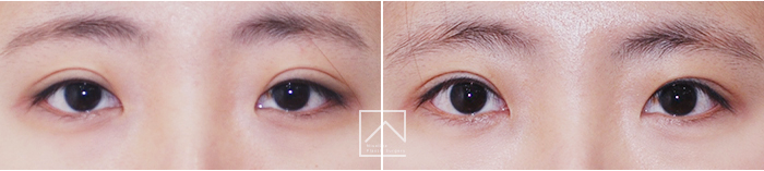 韩国misoline双眼皮修复