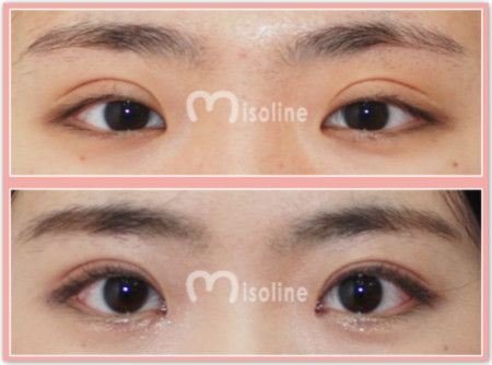 韩国Misoline医院做双眼皮修复怎么样？有没有案例值得看