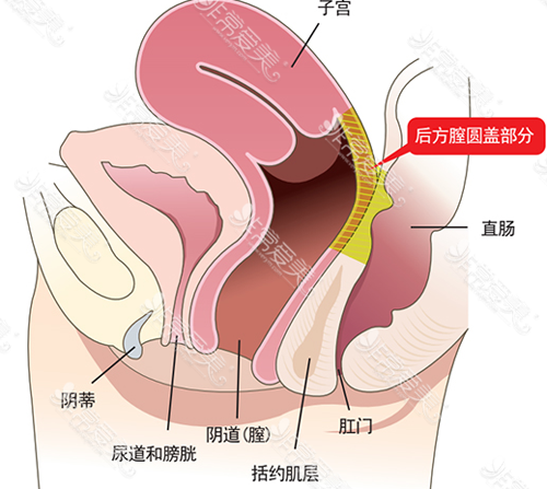 后方膣圆盖术手术位置