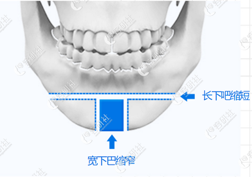 韩国dr.朵医院下巴t型截骨手术示意图