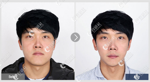 韩国菲斯莱茵整形医院男士面部轮廓手术案例