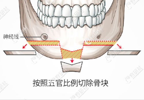 韓國id醫(yī)院鉆石截骨術(shù)示意圖