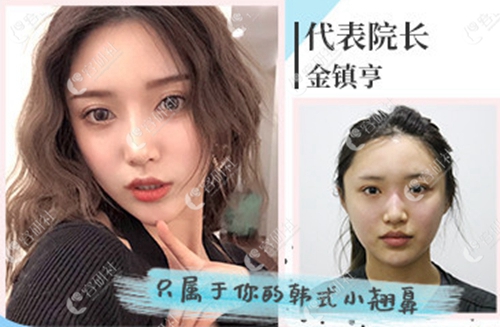韩国女神整形外科鼻修复案例