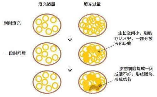 脂肪填充適量與過量