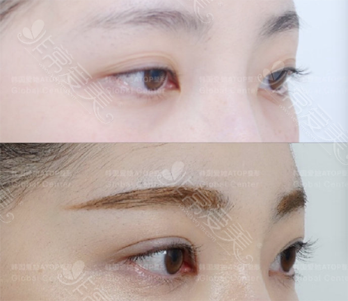 韩国爱她医院双眼皮手术