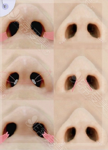 鼻孔整形手术方式图集