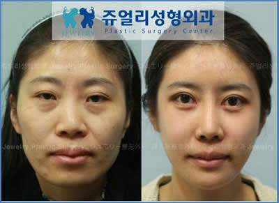 韩国珠儿丽轮廓眼鼻手术效果