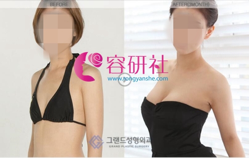 韩国高兰得整形医院隆胸手术案例