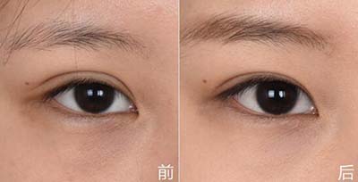 韩国爱丽克整形医院眼部修复案例图