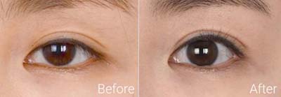 韩国爱丽克整形医院眼部矫正前后对比照