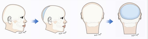 韩国雕刻整形外科医院后脑勺填充示意图