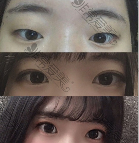 韩国初雪医院双眼皮案例
