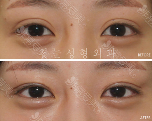 韩国初雪chutnoon整形医院双眼皮修复案例分享