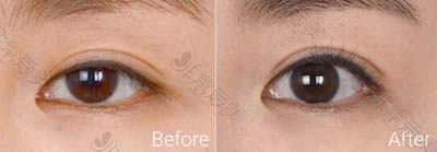 韩国爱丽克医院眼型矫正前后照片