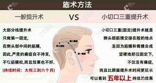 韩国普罗菲耳profile整形医院小切口三重提升术与一般提升术区别