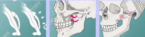 韓國(guó)njh整形醫(yī)院顴骨顴弓整形特色