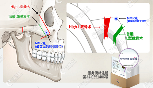 韩国id医院颧骨颧弓整形特色