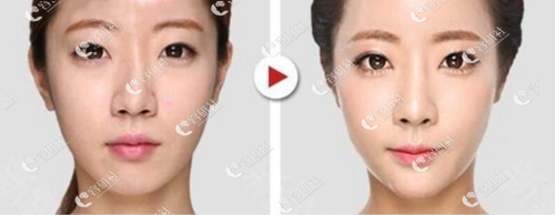 韩国欧佩拉整形外科歪鼻修复案例