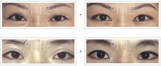韩国李喜文双眼皮修复案例对比