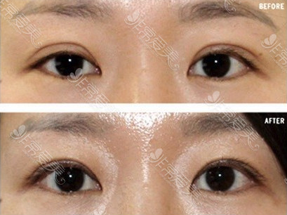 韩国初雪整形外科双眼皮修复对比
