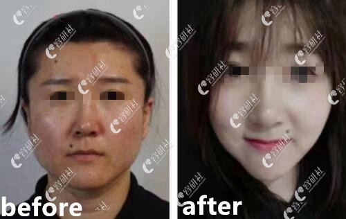 韩国爱她（ATOP）整形外科医院面部吸脂案例