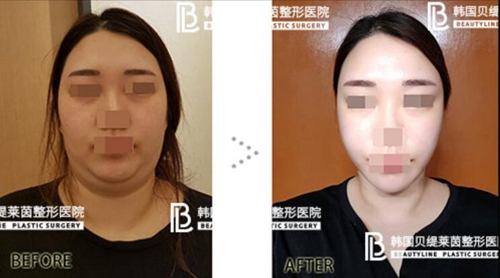 韩国贝缇莱茵整形医院面部吸脂前后对比