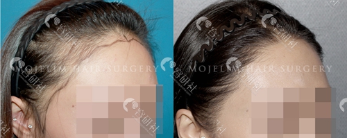 韩国毛杰琳整形外科女性发际线种植前后效果对比