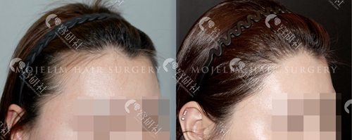 韩国毛杰琳整形外科发毛发移植案例