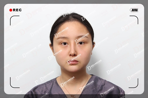 自从在韩国女神整形医院做完面部轮廓手术后,走上了网红路