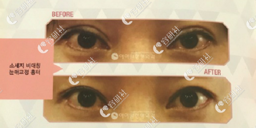 韩国iwant整形医院双眼皮修复案例