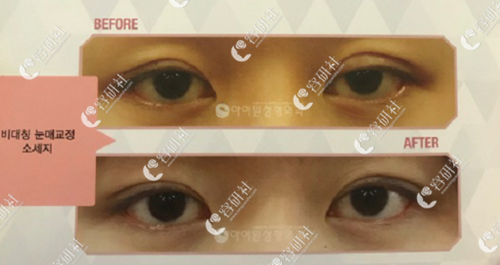 韩国iwant整形医院双侧不对称双眼皮修复案例