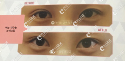 韩国iwant整形医院双眼皮弧度不佳修复案例