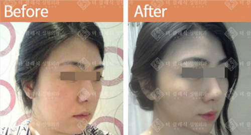韩国德克莱斯整形外科医院3D立体微创童颜提升术（小切口提升术案例）
