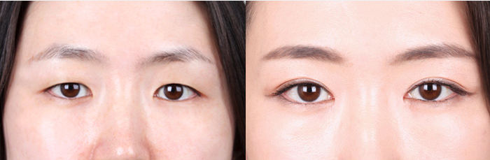 韩国k整形外科眼部综合案例对比