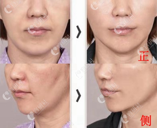 韩国明星线整形外科颈纹提升案例