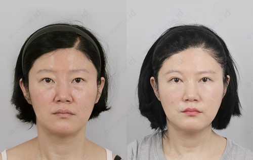 韩国ID整形医院脂肪填充案例