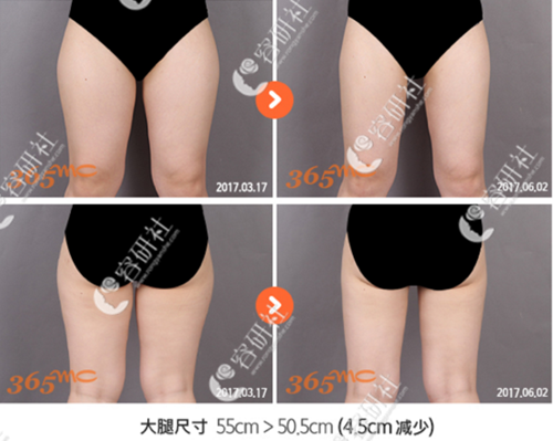 韩国365mc医院大腿吸脂案例