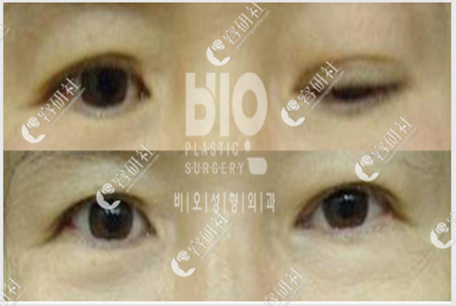 韩国BIO整形医院大小眼修复案例