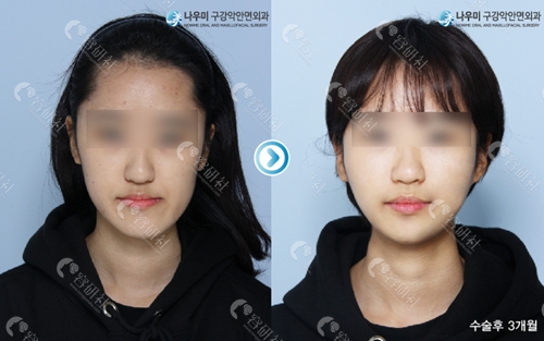 韩国now美口腔颌面外科双鄂手术案例